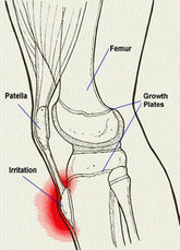 Growth plate injuries - treated by Dunsborough physios