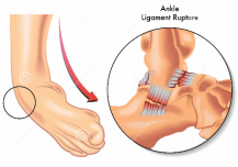 ankle sprains - Dunsborough Physiotherapy Centre