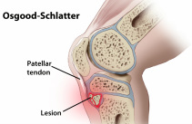 osgood-schlatter disease treated at Dunsborough Physiotherapy Centre