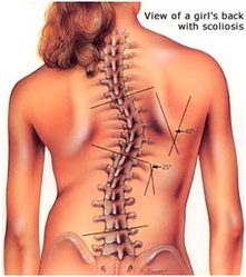 scoliosis - dunsborough physiotherapy centre