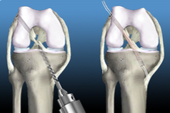 ACL reconstruction - Dunsborough Physiotherapy Centre explanation