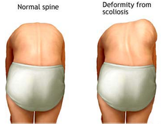 scoliosis testing at Dunsborough Physiotherapy Centre