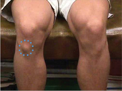 Growth plate injury - knee - physiotherapy involvement
