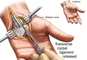 carpal tunnel surgery - physio helps