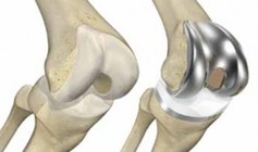 Total Knee Replacement - Rehab provided at Dunsborough Physio Centre