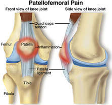 patellofemoral syndrome - Dunsborough Physiotherapy Centre help