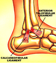 Dunsborough Physio Rehab - ankle stabilisation surgery