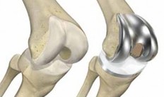 total knee replacement - dunsborough physio treatment