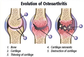 osteoarthritis - treatment at Dunsborough Physiotherapy Centre
