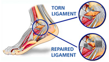 ligament repair explained by dunsborough physiotherapist