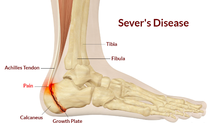 Sever's disease - Dunsborough Physio