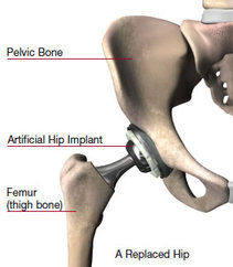 total hip replacement seen at Dunsborough Physiotherapy Centre