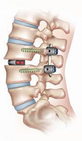 Spinal Fusion - explained by Dunsborough physiotherapist