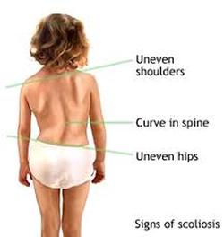 Scoliosis posterior view