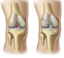 Dunsborough Physio ACL reconstruction information