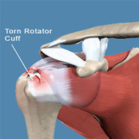 Rotator Cuff injuries - Dunsborough physio info