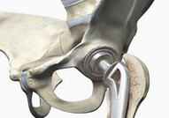Total Hip Replacement Rehab - Dunsborough Physiotherapy Centre